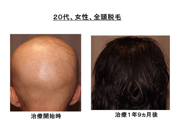 円形脱毛症　病院""